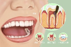 牙齒中間(jiān)有(yǒu)黑(hēi)洞，很(hěn)可能是死髓牙！